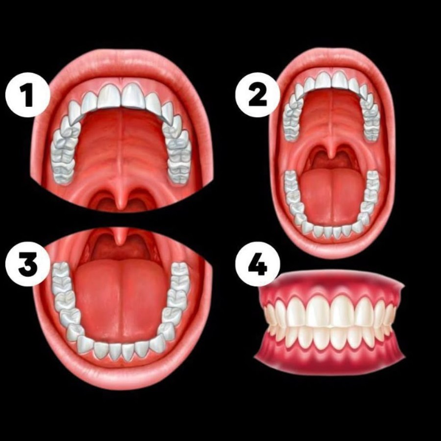 Les 4 photos à prendre : mâchoire du haut, bouche ouverte, mâchoire du bas, dents serrées de face